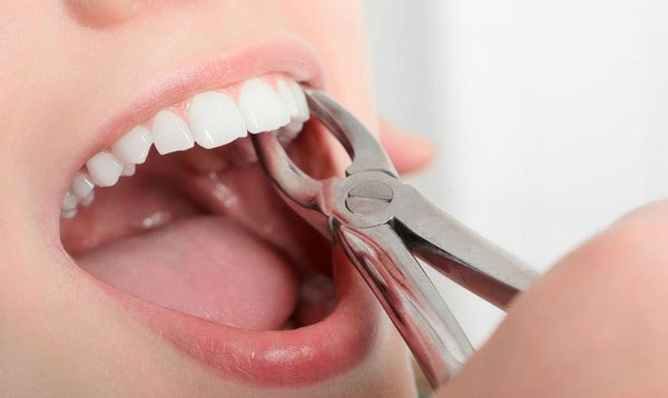 Nhổ răng chỉnh nha cần lưu ý những gì?
