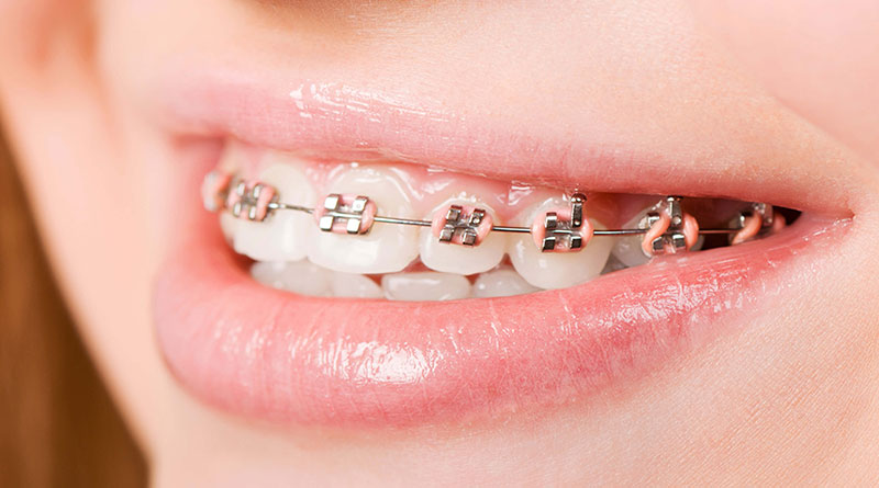 Niềng răng chỉnh hàm có đau không?