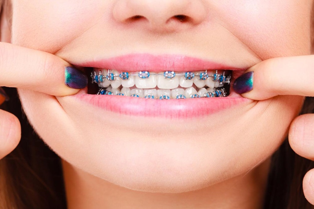 Những yếu tố ảnh hưởng đến thời gian niềng răng