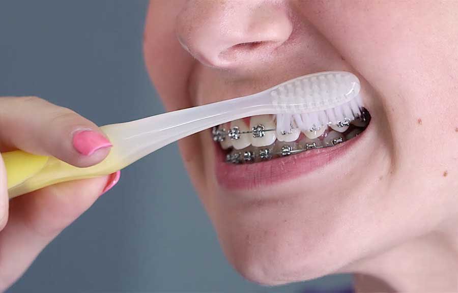 Niềng răng thì đánh răng như thế nào?