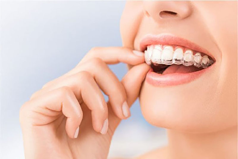Nẹp răng trong suốt Invisalign
