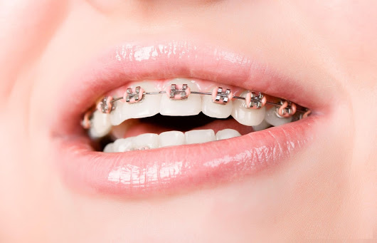 Niềng răng chỉnh hàm đem lại kết quả như thế nào?
