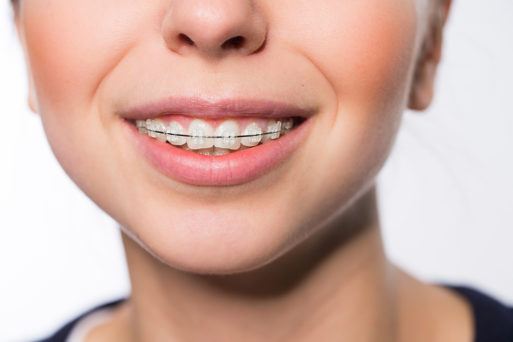 Kinh nghiệm đi niềng răng – Nên niềng răng ở độ tuổi nào?