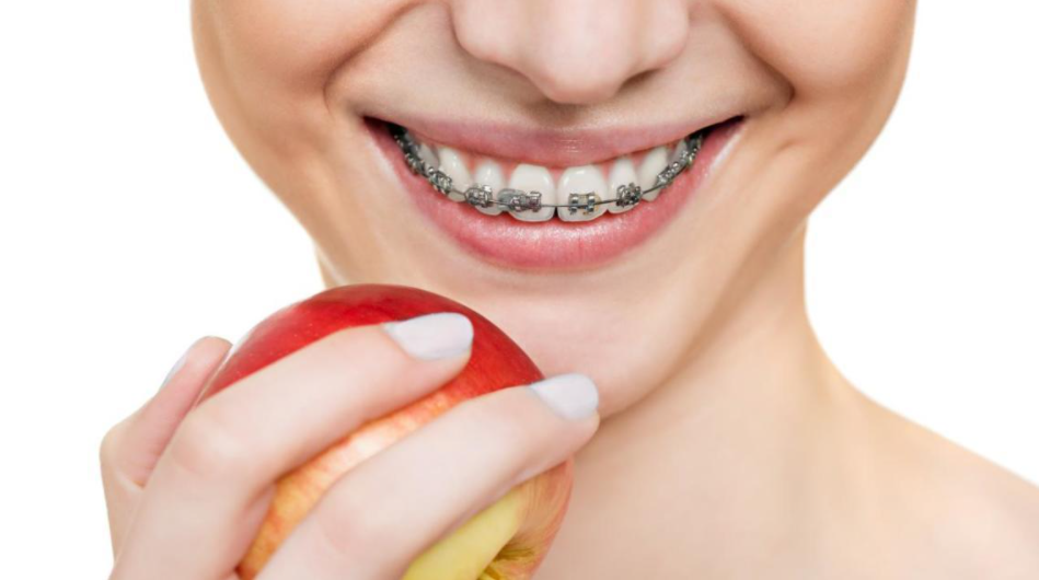 Niềng răng 1 hàm có được không