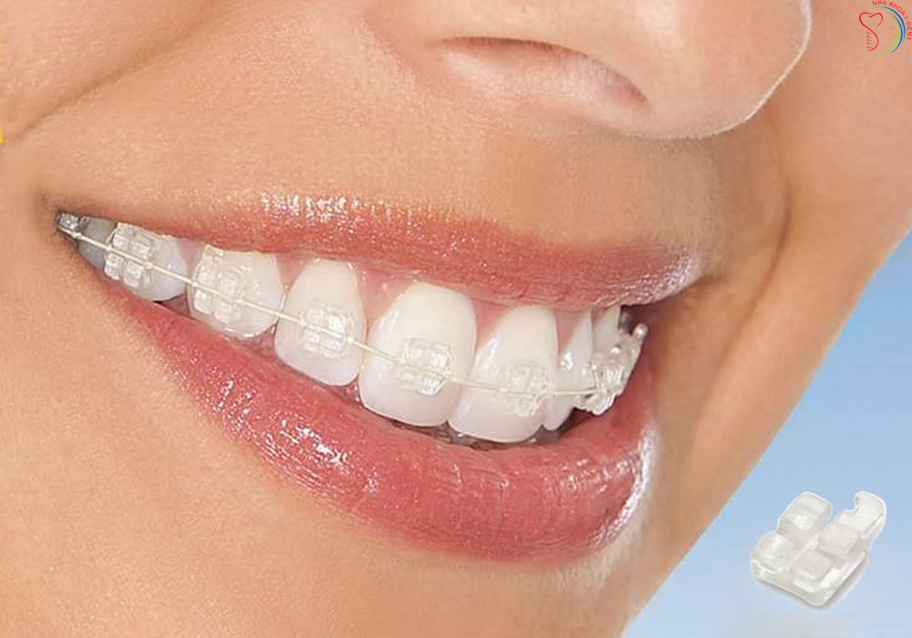 Niềng răng ở đâu tốt nhất TPHCM