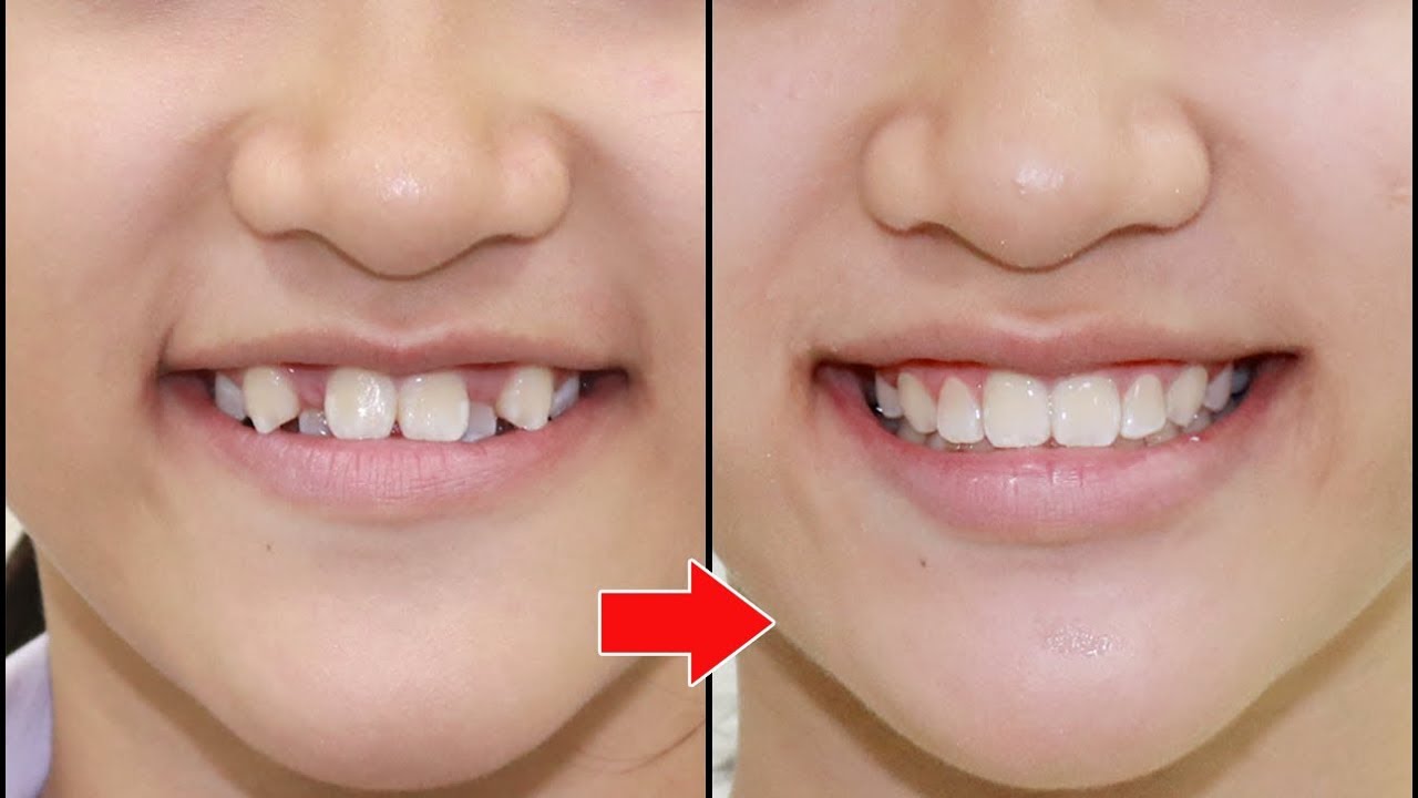Niềng răng có làm thay đổi khuôn mặt không
